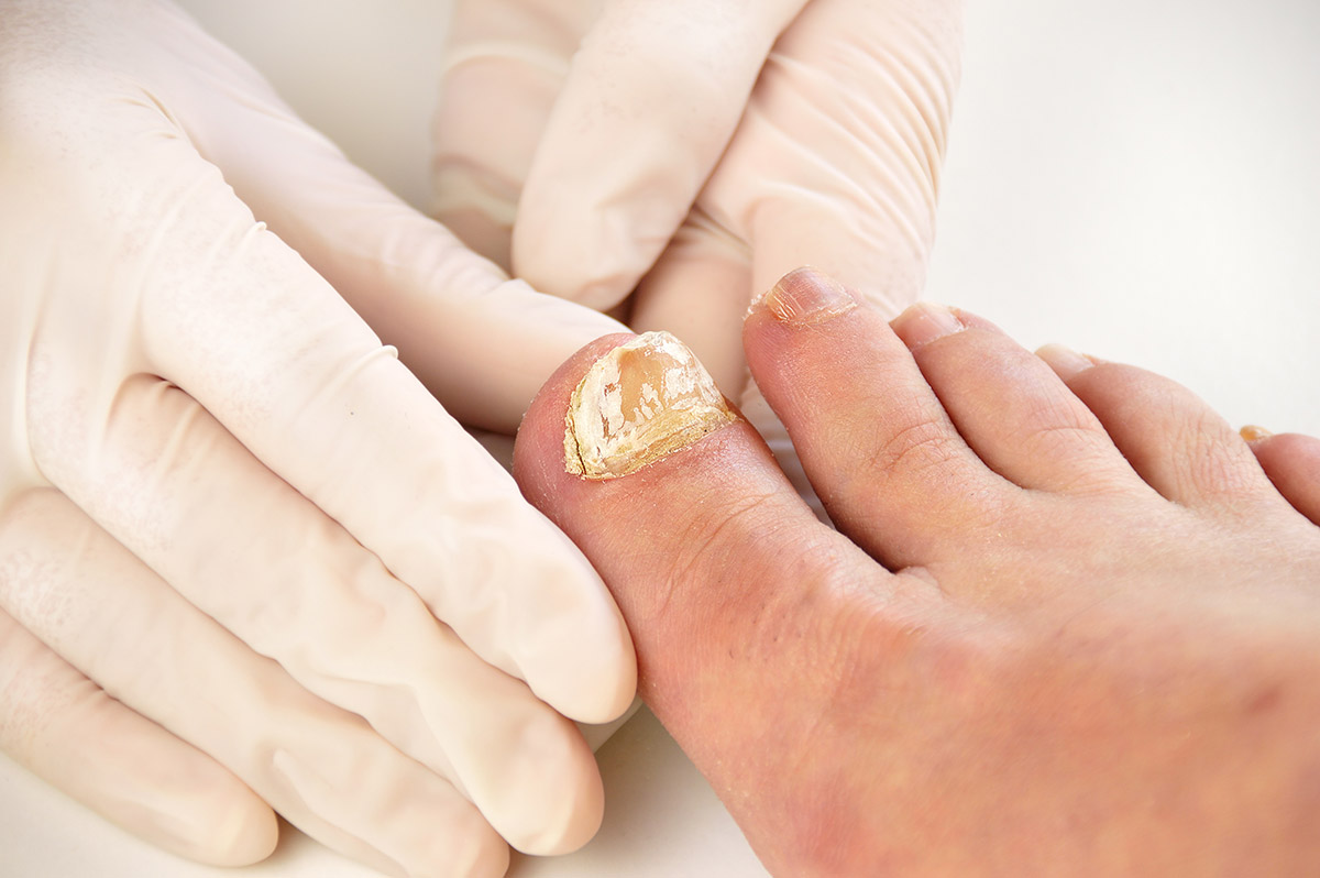 A close-up of a person's foot with a fungal infection.